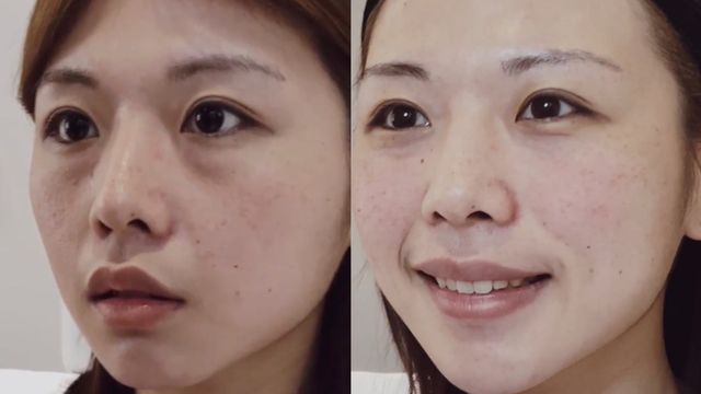 玻尿酸填補蘋果肌淚溝 肉毒咀嚼肌
