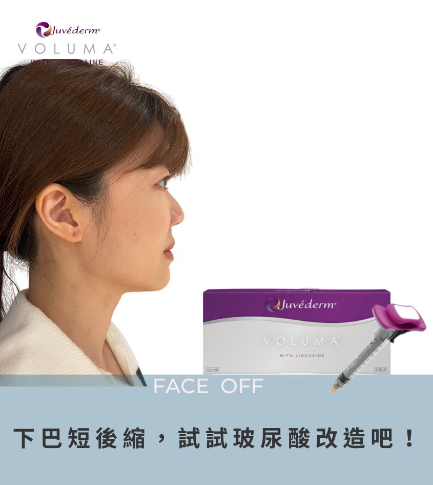 喬亞登玻尿酸下巴