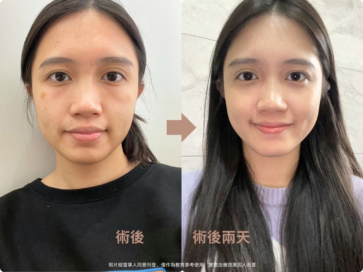 「双美膚力原膠原蛋白植入劑」（俗稱雙美膠原蛋白針、稚齡針、熊貓針、膠原蛋白熊貓針）