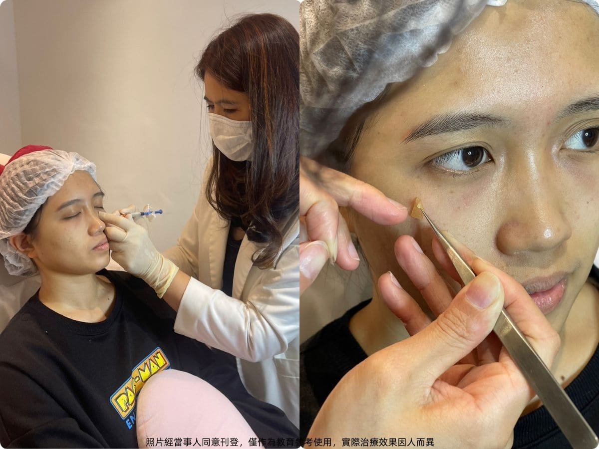 「双美膚力原膠原蛋白植入劑」（俗稱雙美膠原蛋白針、稚齡針、熊貓針、膠原蛋白熊貓針）