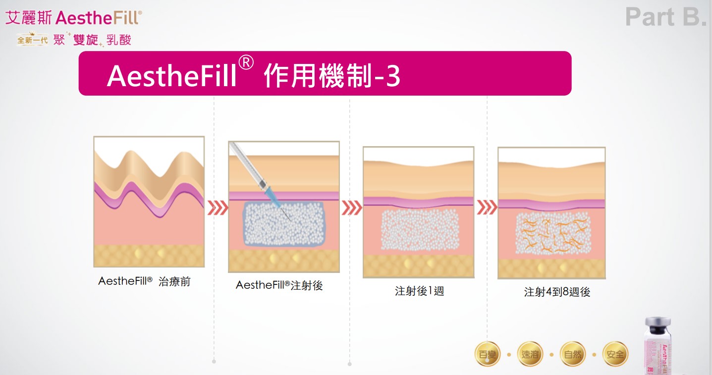 AestheFill 艾麗斯皮下填補劑 童顏針