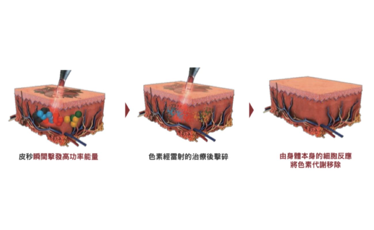Picocare 皮秒雷射 皮秒蜂巢電射