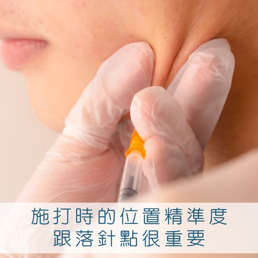 咀嚼肌肉毒施打時的位置精準度跟落針點很重要